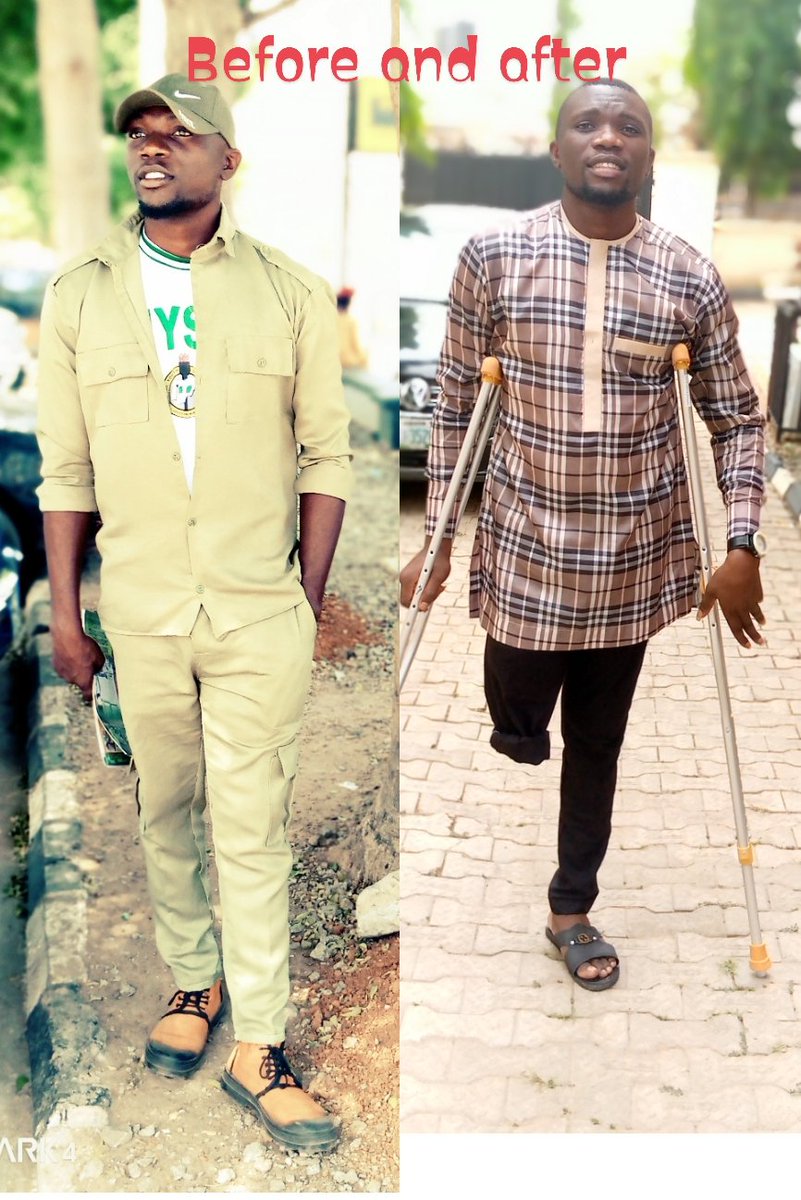 owunna_julian's tweet photo. What a life!! Pls friends I need to work again a prosthetics is needed,
Only God will bless you if you contribute for my well being. Amen https://t.co/9TuKzh7z0d