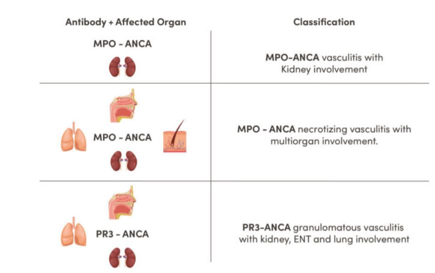 ERAkidney's tweet photo. ⚡CKJ Review:
Proposal for a more practical classification of antineutrophil cytoplasmic antibody-associated vasculitis 
📸Proposed classification of AAV kidney disease
📖Read more here, fully #openaccess:
👉https://t.co/VcNnWP5oLj
@asbomback @CKJsocial https://t.co/f6gR6NvxQY