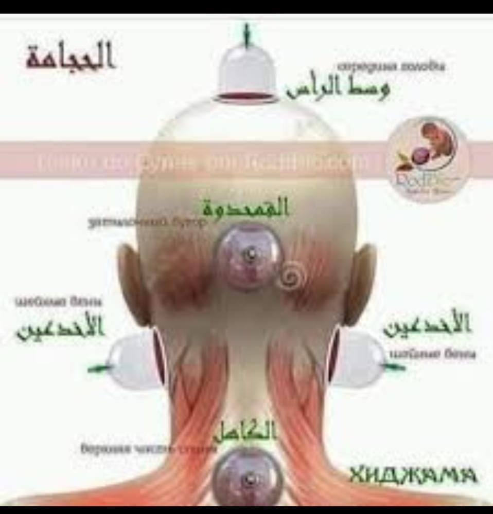 الاخدعين مواضع الحجامة