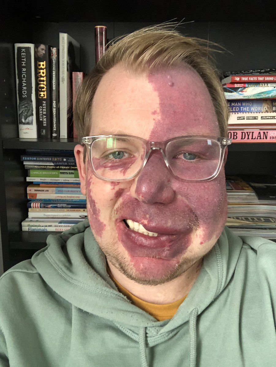 PeterDSteele's tweet photo. So good to see so many people getting involved in #FaceEqualityWeek let’s keep on talking, raising awareness and educating. #myvisibledifference https://t.co/1tAs8uZECx