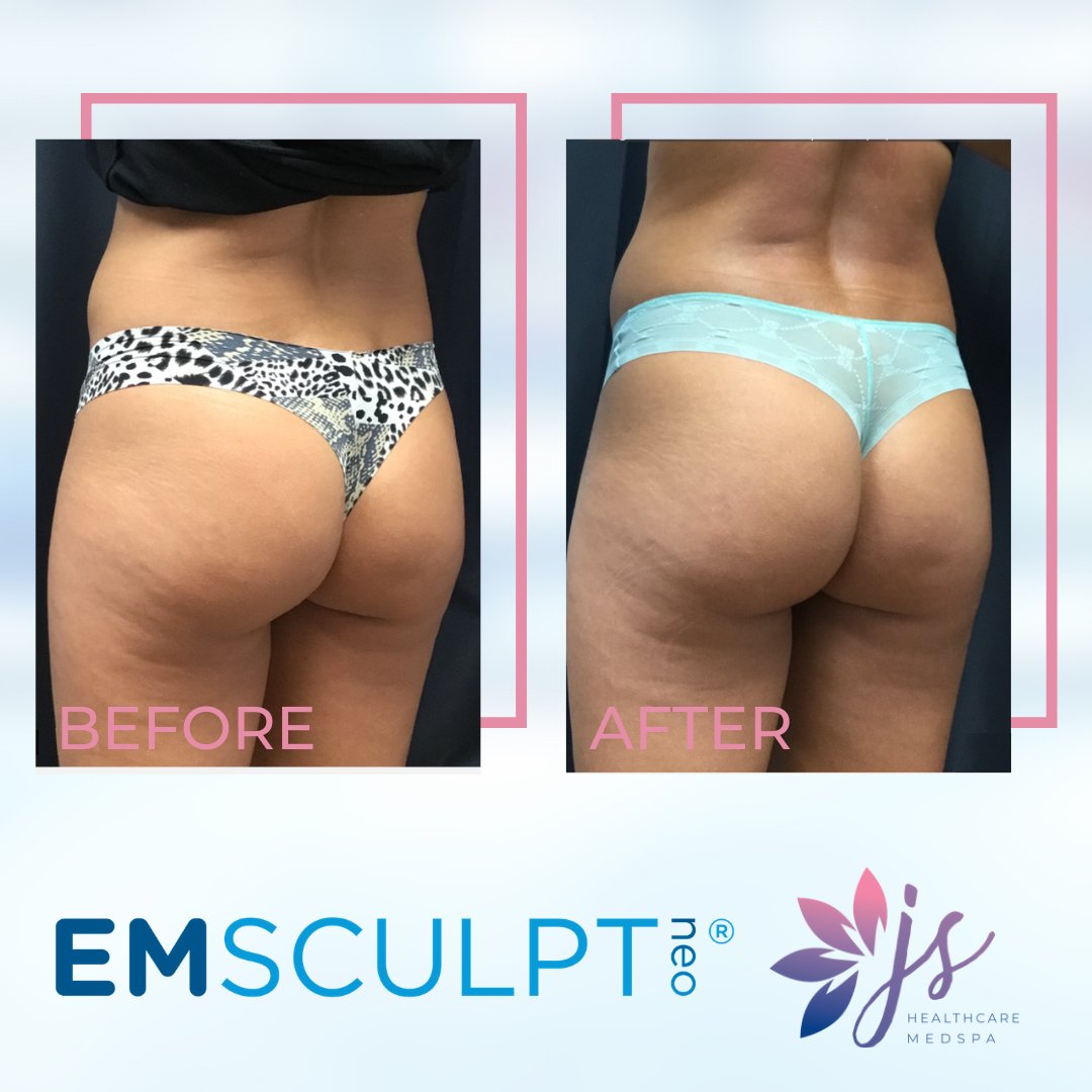 jshealthcaremd's tweet photo. Ditch those squats! The BUTT LIFT results are in.... and WOW! ππ₯20,000 squats in 30 mins x 4 treatments 2-5 days apart = AMAZING RESULTS!
β
Equivalent of 12-16 weeks of #HIIT
β
Av 30% fat reduction
β
Av 25% increase in muscle mass
#MoreMuscleLessFat #EMSCULPTWEEK #winterpark https://t.co/NfMynHf9wA