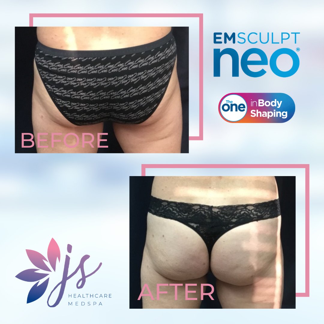 jshealthcaremd's tweet photo. Ditch those squats! The BUTT LIFT results are in.... and WOW! ππ₯20,000 squats in 30 mins x 4 treatments 2-5 days apart = AMAZING RESULTS!
β
Equivalent of 12-16 weeks of #HIIT
β
Av 30% fat reduction
β
Av 25% increase in muscle mass
#MoreMuscleLessFat #EMSCULPTWEEK #winterpark https://t.co/NfMynHf9wA