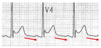 drahmedmohsen85's tweet image. Young patient presenting with acute stitching chest pain
What is the most likely explanation ?
Vote now in Medshr!
The correct answer will be provided after 24 hours in CQ Medshr group
Join now for free from here 
medshr.it/cardioquizzes
#cardiotwitter