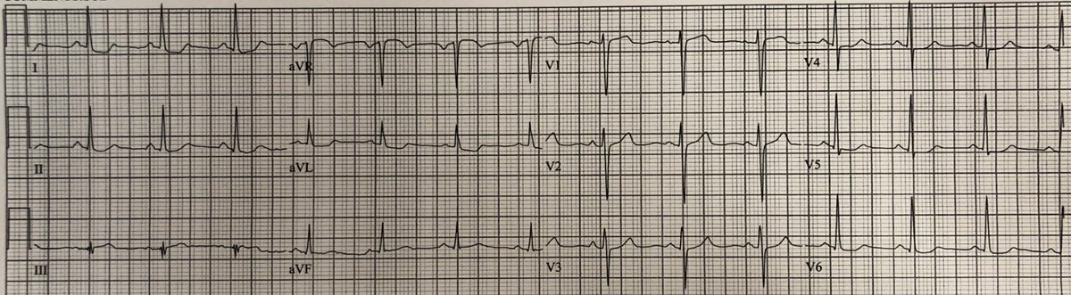 smithECGBlog's tweet photo. Typical Chest Pain: Would you activate the cath lab? Would you advocate if the interventionalist was not interested?

https://t.co/Y4GIw4DtwA

@AslangerE https://t.co/z7gB7mHYgq