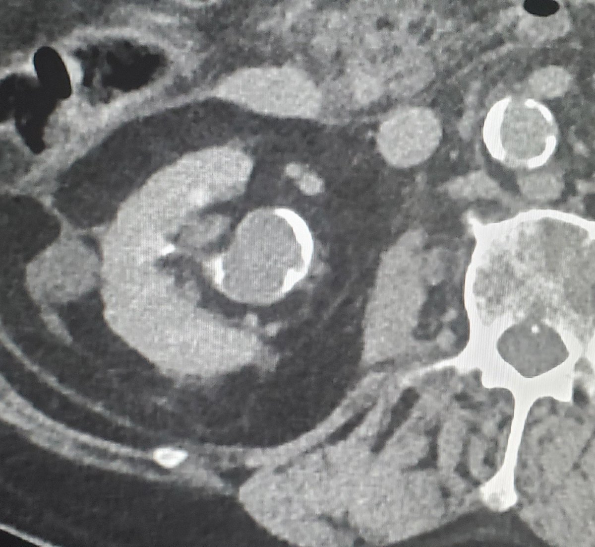 Olga R Brook, MD, FSAR, FSIR, FSABI, FESGAR (@olgabrook) on Twitter photo Non-surgical candidate, renal pelvis mass: #irad would you do the biopsy?
<a href="/CsirEtc/">CSIR_ETC_SAR</a> <a href="/SIRspecialists/">Society of Interventional Radiology</a> Non-surgical candidate, renal pelvis mass: #irad would you do the biopsy?
<a href="/CsirEtc/">CSIR_ETC_SAR</a> <a href="/SIRspecialists/">Society of Interventional Radiology</a>