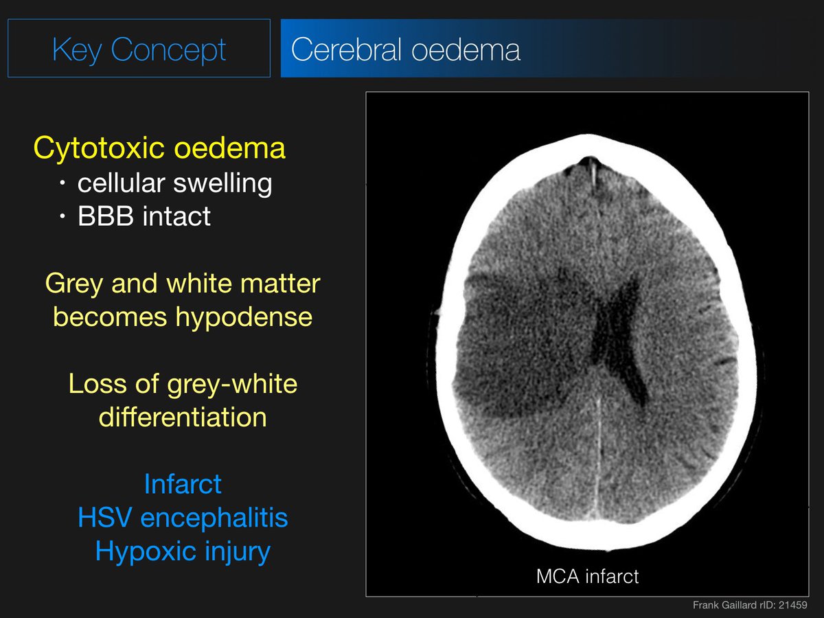 Radiopaedia's tweet photo. Our free Friday livestream is coming up in under 30 minutes featuring a CT Brain lecture by @DrAndrewDixon - join us in the live chat!

WATCH: https://t.co/44YmDBlh48 #foamed #foamrad 

In support of the #radiopaedia2021 virtual conference July 19-23. https://t.co/xEA7LDYTxB