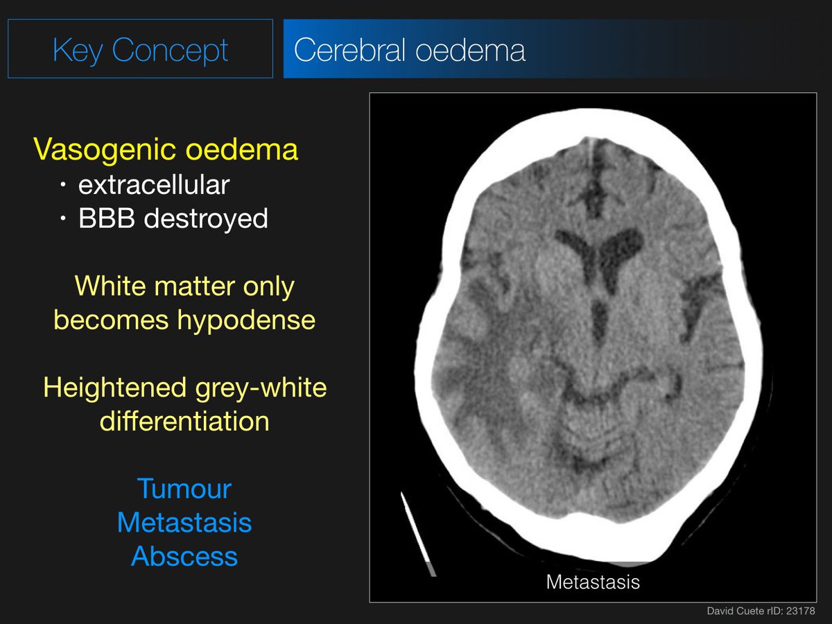Radiopaedia's tweet photo. Our free Friday livestream is coming up in under 30 minutes featuring a CT Brain lecture by @DrAndrewDixon - join us in the live chat!

WATCH: https://t.co/44YmDBlh48 #foamed #foamrad 

In support of the #radiopaedia2021 virtual conference July 19-23. https://t.co/xEA7LDYTxB