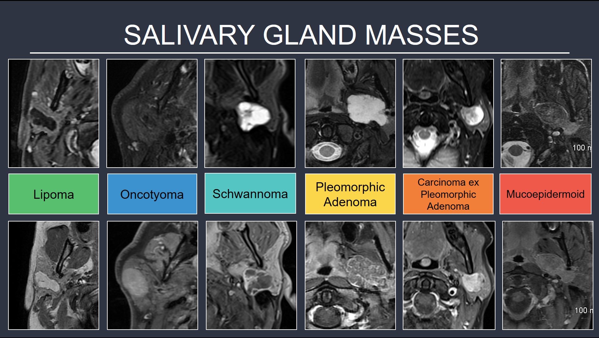 Tabby A. Kennedy, MD on Twitter "Salivary gland masses Ddx is broad
