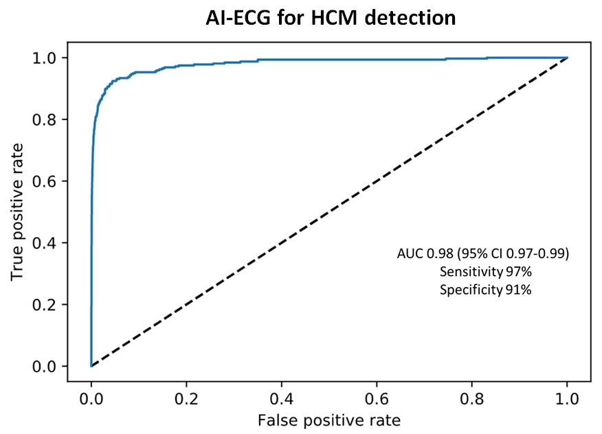 Detecting  #HCM by applying an AI-ECG algorithm