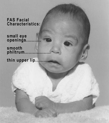 5. Abnormal Appearance like;- Small head- Low weight- Short stature, etc6. Joint DeformitiesAll these symptoms make up the "Fetal Alcohol Syndrome"."NO AMOUNT OF ALCOHOL IS OK IN PREGNANCY, DON'T DRINK AT ALL!"The drinking can wait till you're done breastfeeding.