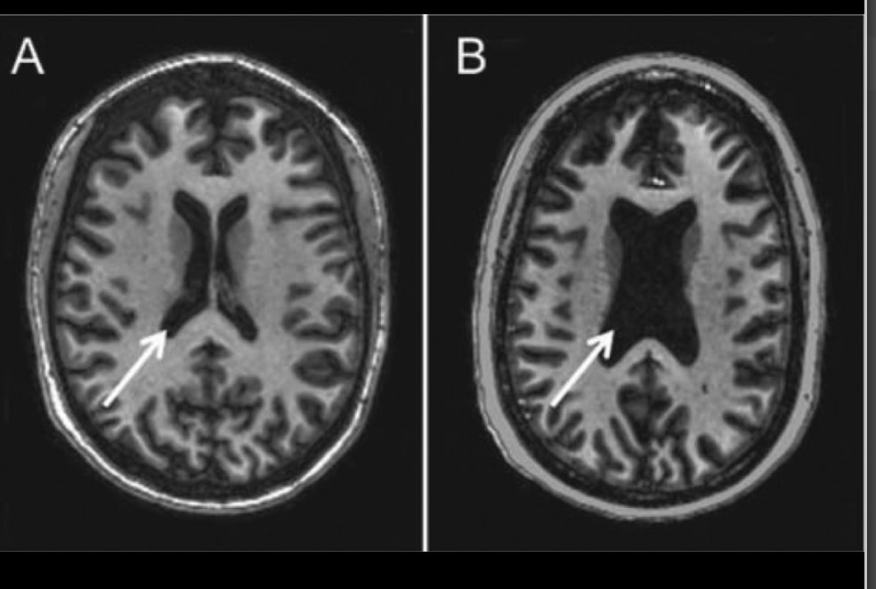 3/ Scientifically, it’s millions of neurons sick, dying or dead. This is depersonalizing & devastating. Fig A shows MRI 3 mos after ICU in pt w/out delirium vs B shows ICU pt w  #Delirium. Duration of delirium predicted loss of  tissue.Our MRI study -  https://bit.ly/3uxAqFQ 