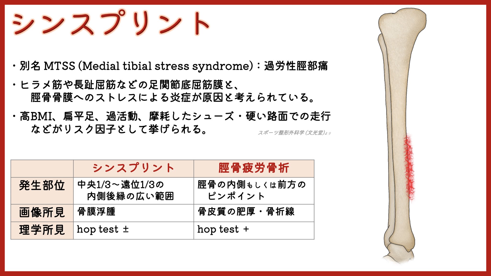 ユジカワ 整形dr イラストレーター シンスプリントと脛骨疲労骨折の鑑別は図の通り 大学時代に毎日 道路とトラックを10キロ走ってたら自分も発症したが 芝生の上を走るように変えてから再発しなくなった イラスト日記 シンスプリト 疲労骨折