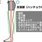 心当たりの方は注意!99%の反り腰の方に当てはまる「反張膝」はマジで厄介!