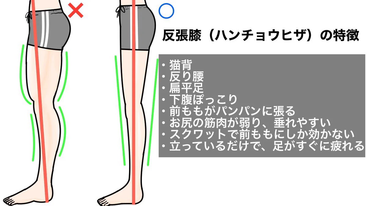心当たりの方は注意！99%の反り腰の方に当てはまる「反張膝」はマジで厄介！
