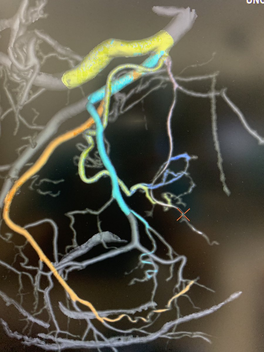 Ari Isaacson (@ariisaacsonmd) on Twitter photo Nice example of multiple feeders to large prostate: yellow-main prostatic artery, orange-distal int pudendal (pena cava), teal-retropublic branch of obturator, pink-distal sup vesical. (Colors courtesy of GE) <a href="/SIRRFS/">SIR RFS</a> <a href="/SIR_ECS/">SIR ECS</a> <a href="/StreamMeeting/">STREAMmeeting</a> <a href="/UsaProstate/">Prostate Centers USA</a> Nice example of multiple feeders to large prostate: yellow-main prostatic artery, orange-distal int pudendal (pena cava), teal-retropublic branch of obturator, pink-distal sup vesical. (Colors courtesy of GE) <a href="/SIRRFS/">SIR RFS</a> <a href="/SIR_ECS/">SIR ECS</a> <a href="/StreamMeeting/">STREAMmeeting</a> <a href="/UsaProstate/">Prostate Centers USA</a>