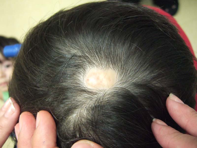 IhabFathiSulima's tweet photo. Non Syndromic #Aplasia #cutis may arise from maternal exposure to ? https://t.co/01caGkhVMs