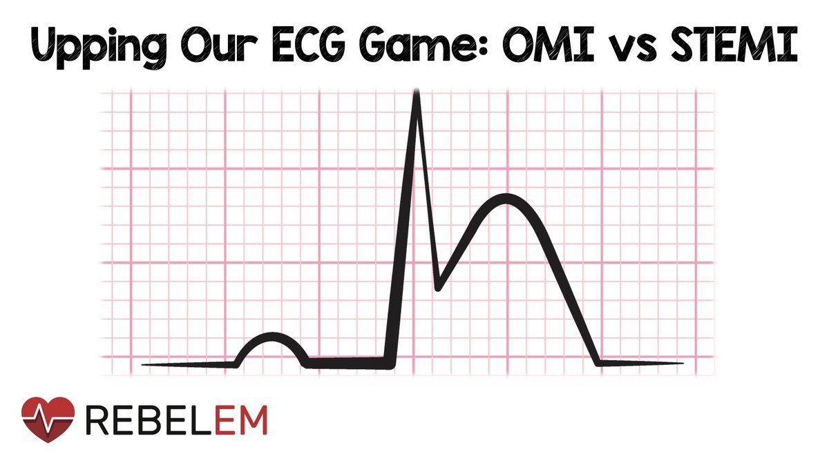 Upping Our ECG Game: OMI vs STEMI

-Subgroup of NSTEMI pts who have acute coronary occlusions similar to STEMI pts
-They don’t meet millimeter STEMI criteria
-Have similar outcome severity
-Less likely to receive emergent cath

rebelem.com/upping-our-ecg…

#FOAMed #STEMI #ECG