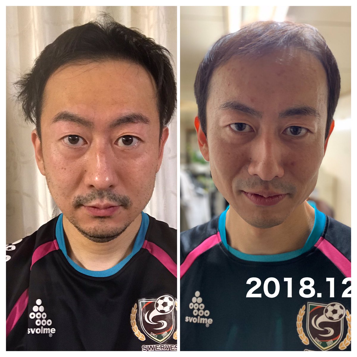 デルピエロ山口 発毛芸人 Delpiero Yh 님 트위터