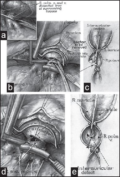 The creation of mixing defects to palliate infants with transposition of the great arteries had been performed since 1948 when Vivien Thomas developed a closed atrial septectomy (Blalock-Hanlon) procedure that was widely adopted, but that carried a non-trivial perioperative risk.