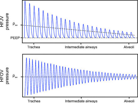 respcare's tweet photo. Miller et al provide a narrative review of high-frequency jet ventilation (HFJV) in neonatal and pediatric subjects. Differences in HFJV & HFOV are highlighted and future research needs described. @agmrrt @kylejrehder #pedsICU #neonatology
https://t.co/E0baQ5XzhK https://t.co/zJSvEtVNW8