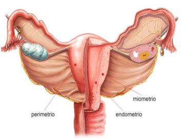 Embarazo endometriosis