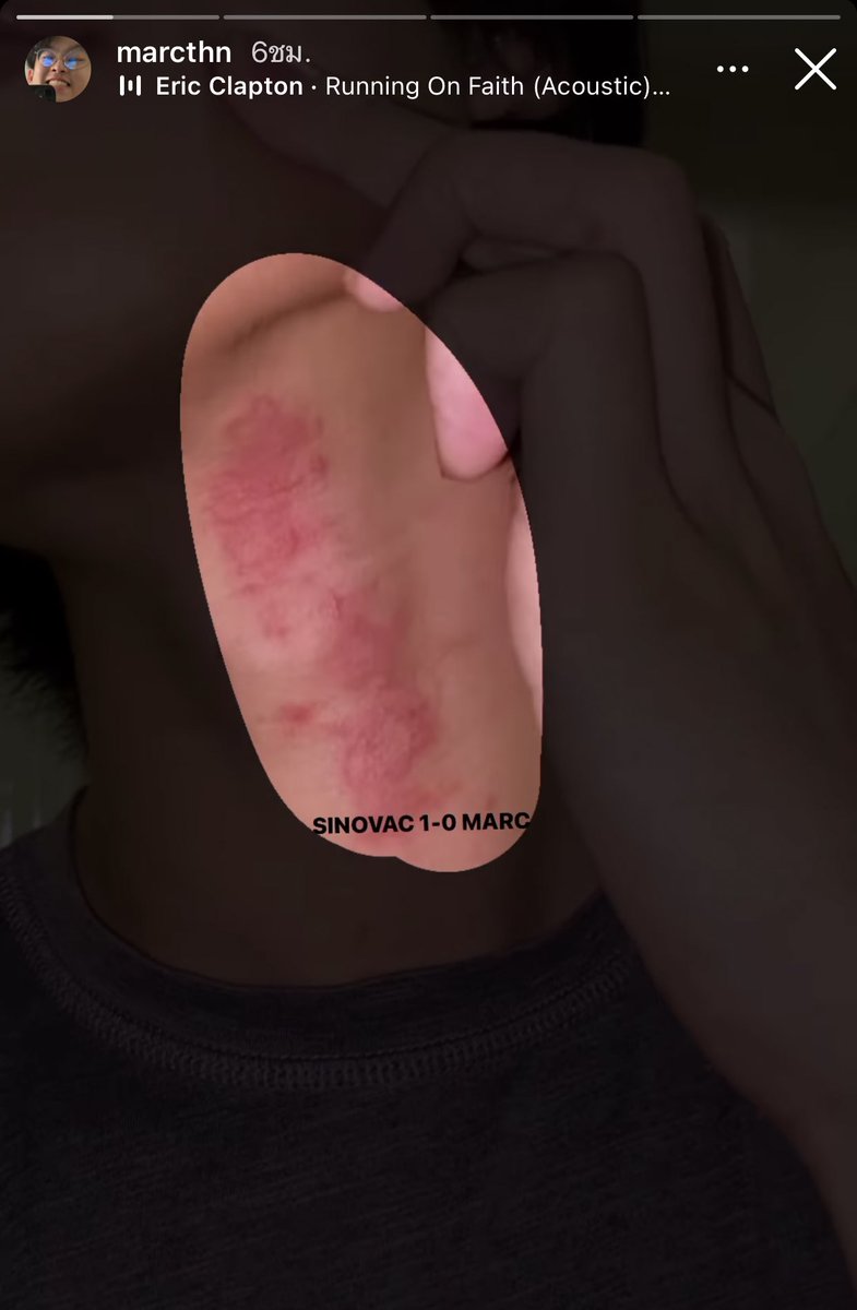 อหหหหหหห มาร์คกามิฉีด sinovac 🥲