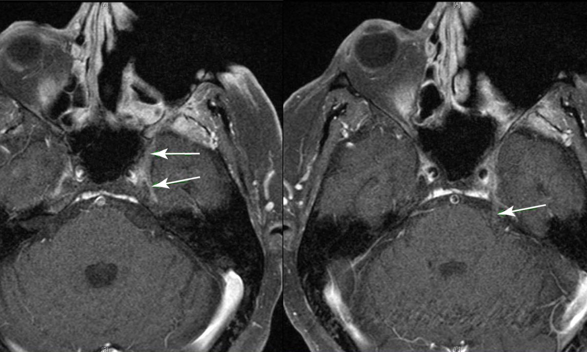 theMJA's tweet photo. Mucormycosis: early treatment is the key to survival ... #freeaccess #preprint ... "A 67-year-old man presented to his rural general practitioner with left facial pain" ... https://t.co/WWdmWoKuEl #medtwitter https://t.co/E8ibZl1tFr
