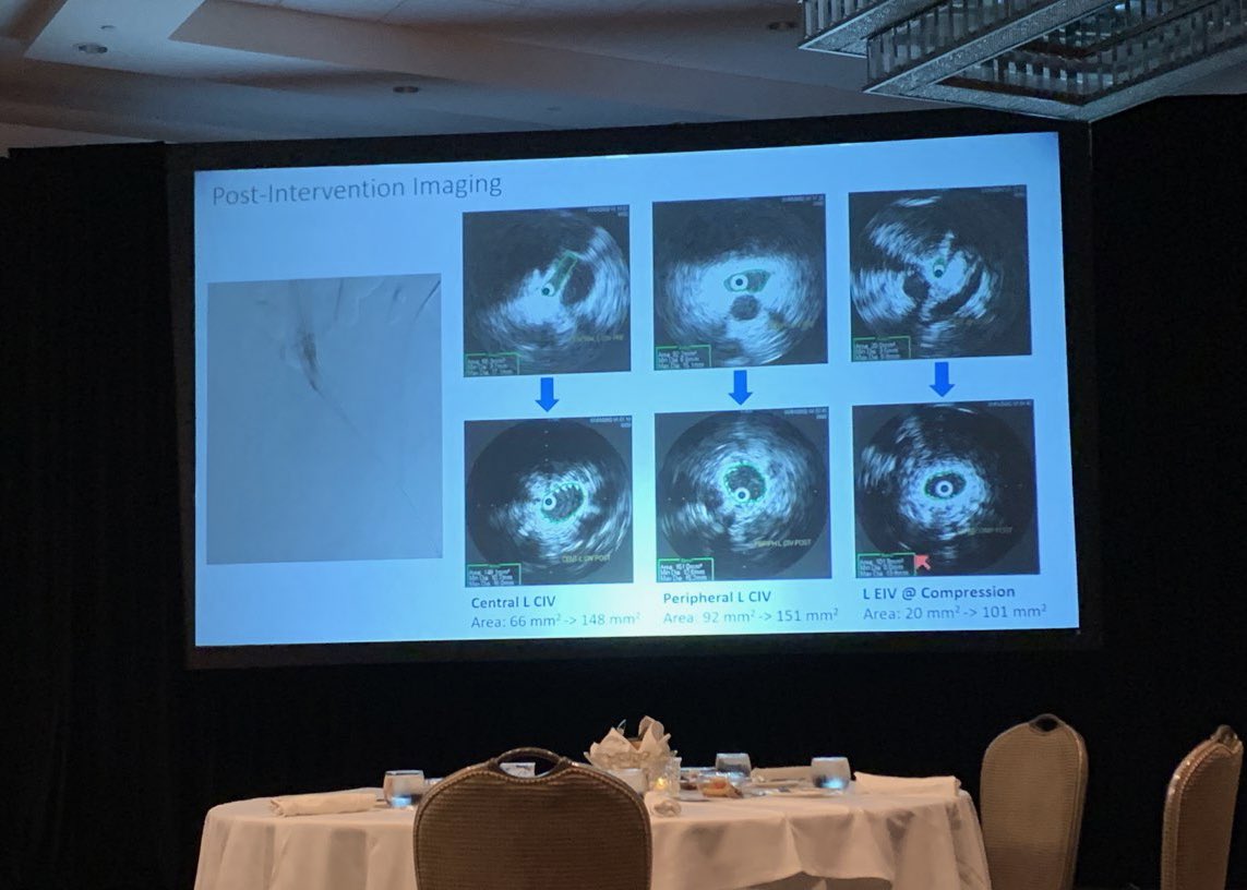 Honored to have won the #Fellowluminaries case competition for the iliofemoral venous category!! Thank you @cookvascular and the panelists for the opportunity to present and loved seeing all the other presentations! #ISET2021 @angiowoman @paragpatel_IR @docTPlive