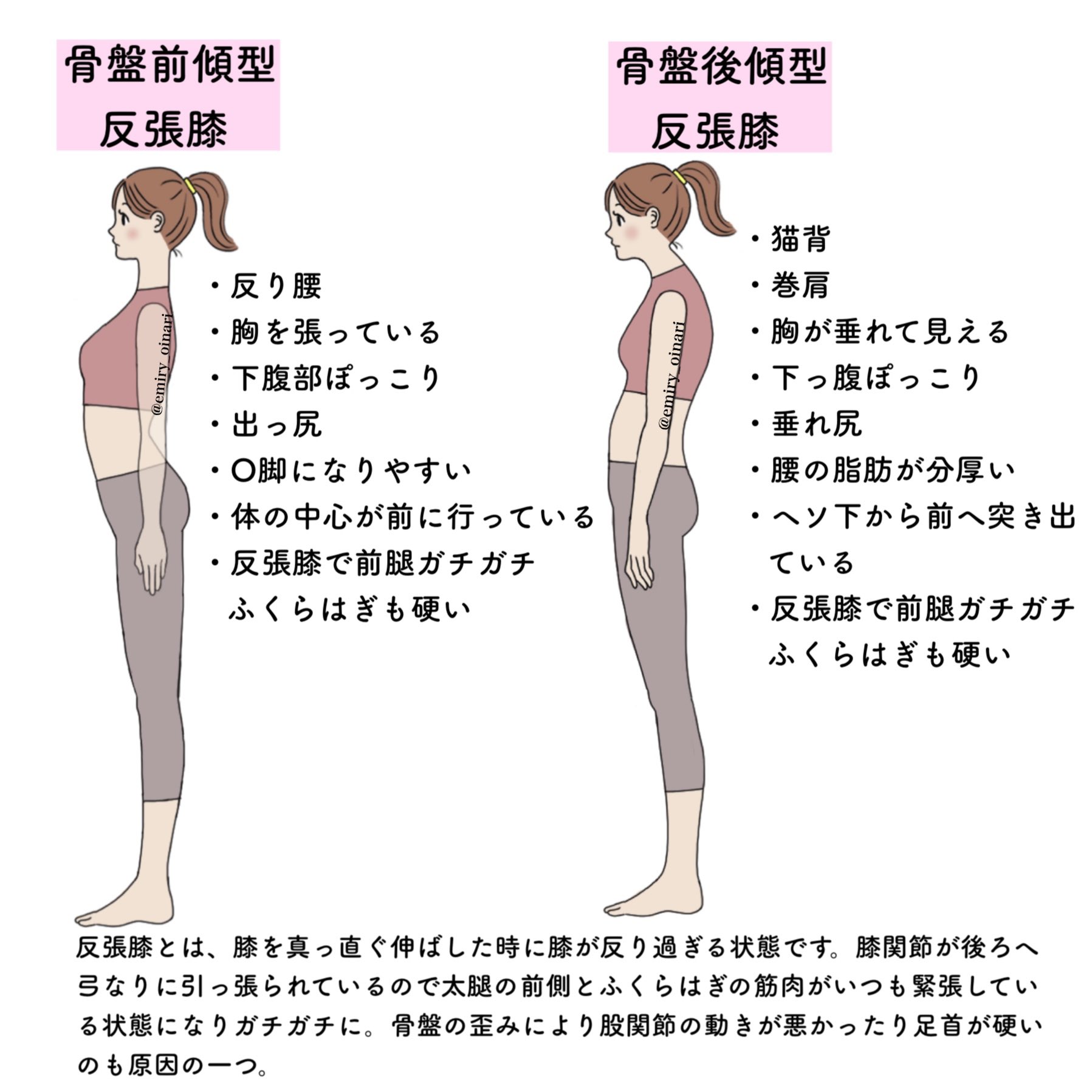 トレえみ 太腿がガチガチで太さが気になる人は反張膝になっている人が多い 膝関節が弓なりに後ろへ反っている状態は太腿の前側が緊張し続けてしまうのでストレッチでしっかりほぐして そして普段の姿勢から気をつけてください 反張膝の人 膝を少 しだけ トレえみ 太腿がガチガチで太さが気になる人は反張膝になっている人が多い 膝関節が弓なりに後ろへ反っている状態は太腿の前側が緊張し続けてしまうのでストレッチでしっかりほぐして そして普段の姿勢から気をつけてください 反張膝の人 膝を少 しだけ