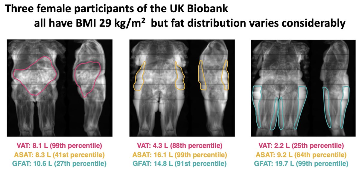 Amit V Khera See Here Examples Of Three Women All With Same Bmi Of 29 Overweight But Not Obese But Very Different Body Fat Distributions When We Look With Mri Amit V Khera See Here Examples Of Three Women All With Same Bmi Of 29 Overweight But Not Obese But Very Different Body Fat Distributions When We Look With Mri