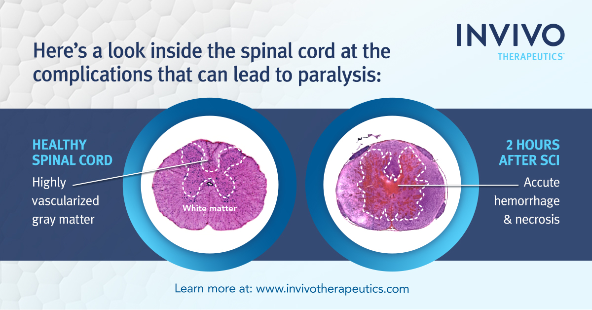 What happens after a #SCI? Early surgery is typical in order to decompress and stabilize the spine. However, even if the spine is successfully stabilized, the initial injury can lead to a cascade of complications. Learn more: bit.ly/3gbT0eB