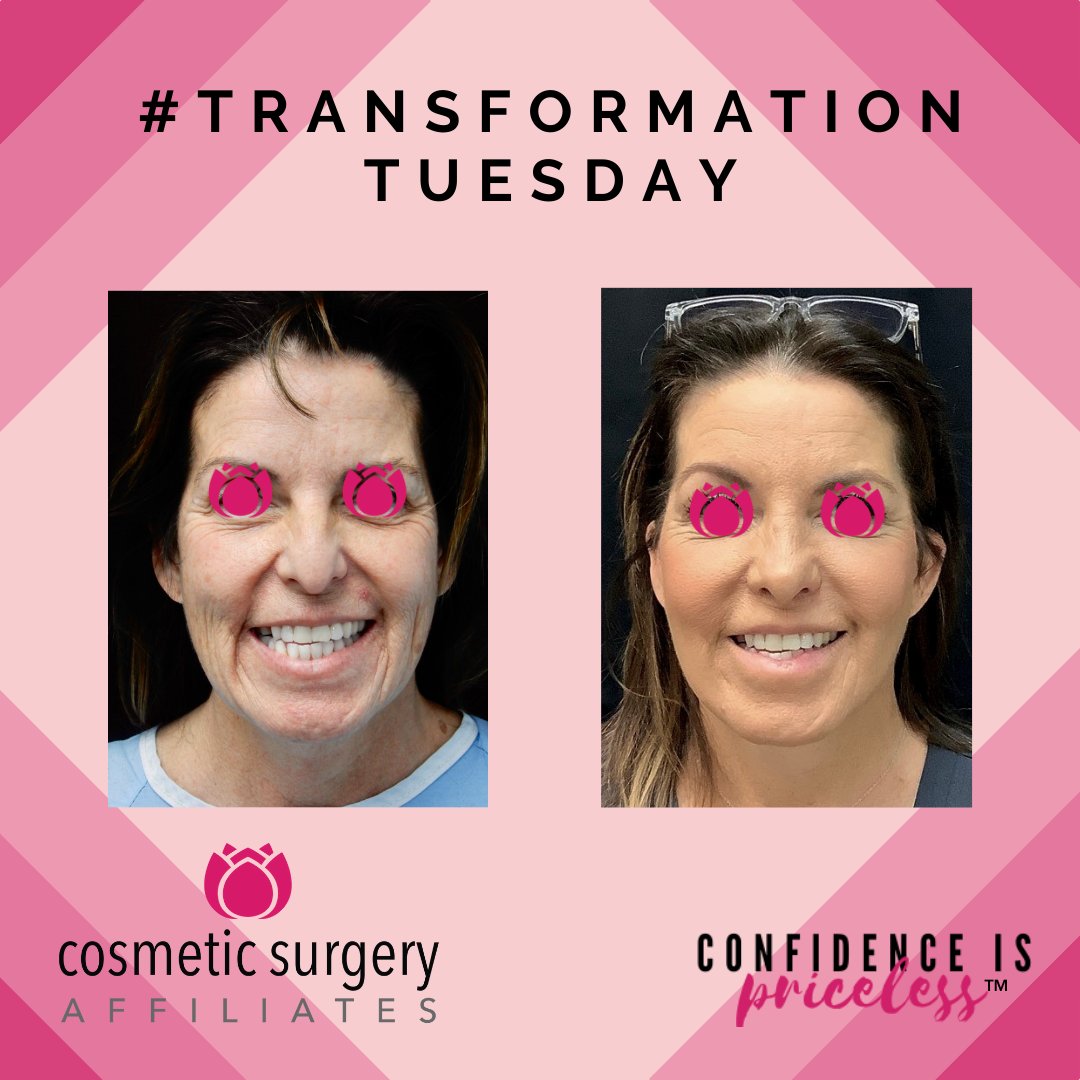 Check out this #FaceLift by Dr. Nuveen for #TransformationTuesday 😍
#cosmeticsurgeon #cosmeticsurgery #cosmeticinjectables #surgerybeforeandafter #beforeandafter #surgery #faceliftbeforeandafter #oklahomasurgeon #oklahomasurgery