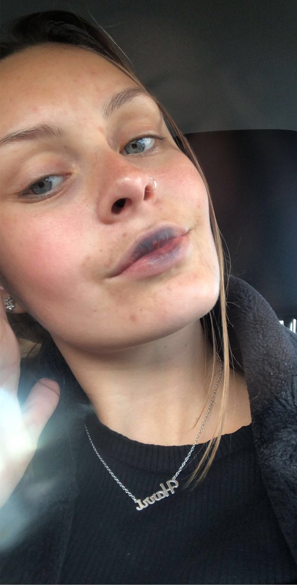 1 year ago today I bought a dodgy lip plumper and turned my lips blue, good times xx