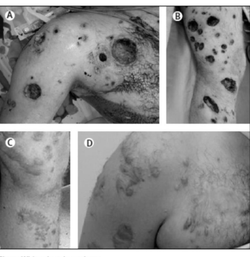 Israel forces using phosphorus shells during they attack Gaza 

phosphorus shells causes both chemical and thermal burns

This is what phosphorus shells causes

 #GazaUnderAttack