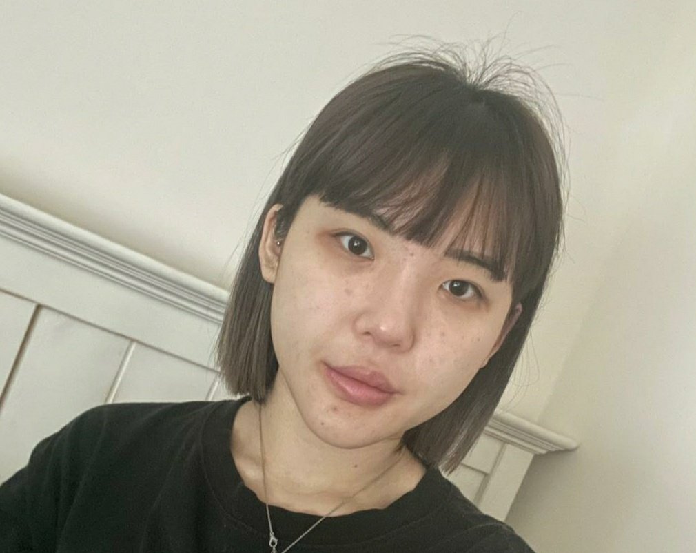 頬骨整形 頬骨整形