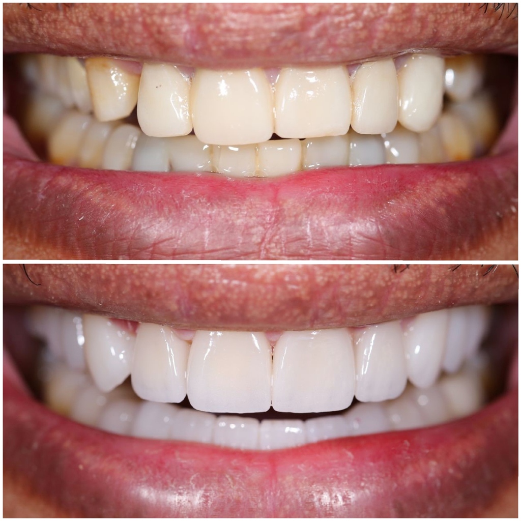 MicrisDental's tweet photo. This patient was suffering with poorly fitting upper and lower #veneers, #crowns, and open spaces. โ
โ
Dr. Marwan gave this patient the smile he deserves, following meticulous planning and with replacements. ๐โ
โ
For details: https://t.co/DqBZKAoRQF
#dubaidental #dxb #uae https://t.co/JqSQ6ZlU7X