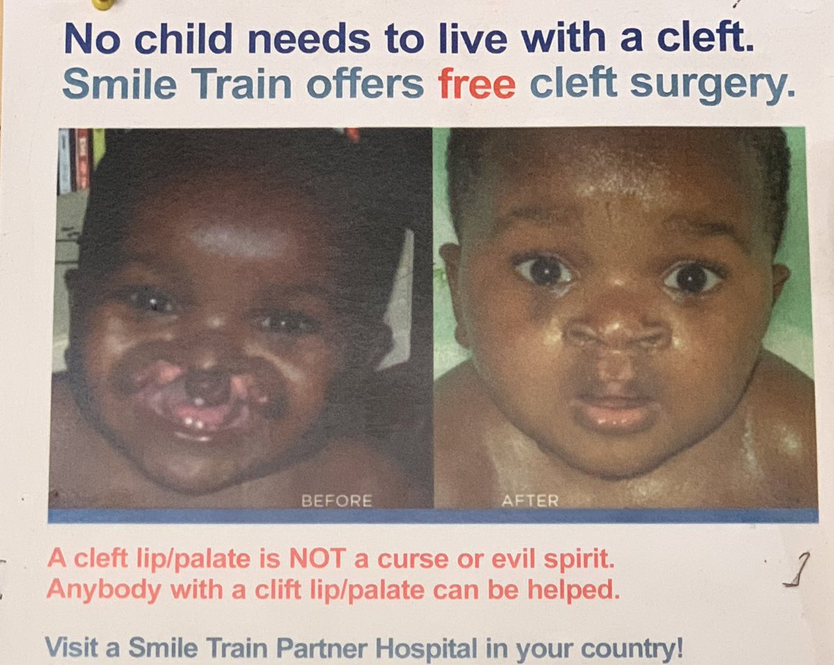 theoluwaseunre's tweet photo. 7:30am and I’m Surgery ready, no child should live with cleft💪🏾 https://t.co/2juB33AmiP