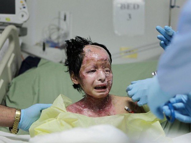 Phosphorus is a chemical weapon that burns the flesh and leeps on the bones only, it’s a prohibited weapon work wide .. but Israel uses it against Palestinians   
#Israel_uses_phosphorus_bombs 
#GazaUnderAttack 
#FreePalestine 
ياااااااااااااااااارب يا الله كن لهم 💔💔💔💔💔🥀