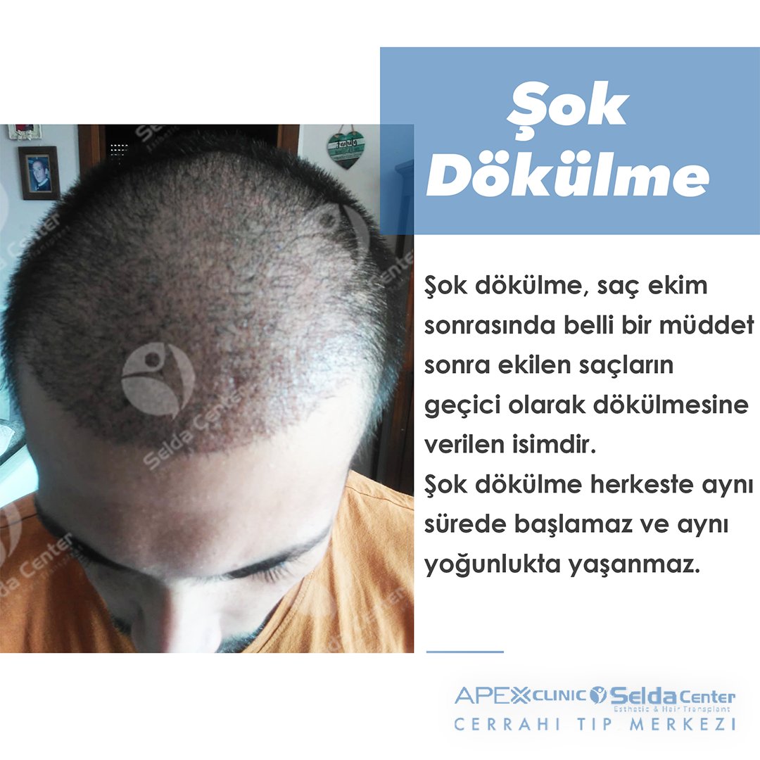 CenterSelda's tweet photo. 👉Saç ekim işleminden sonra ikinci hafta ile üçüncü ay arasındaki süreçte ekilen saçlarda şok bir dökülme yaşanır.
👉In the period between the second week and the third month after hair transplantation, there is a shock loss in the transplanted hair.
#şokdökülme #shockloss https://t.co/MLV32G5zHQ