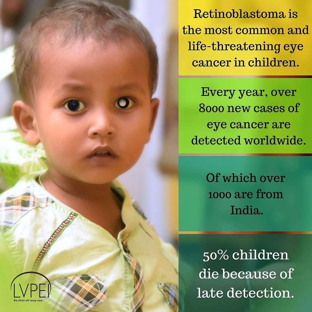 lvpeiwhitathon's tweet photo. 🎗 #Retinoblastoma is one of the rare #cancers that most commonly affects #children below the age of 3 years.

👉 If you notice a white reflex or a glow or a lazy eye, consult an eye specialist at the earliest.

#RetinoblastomaAwarenessWeek #LVPEI #SaveVision #SaveLife
#Whitathon https://t.co/qNgpdZ16mb