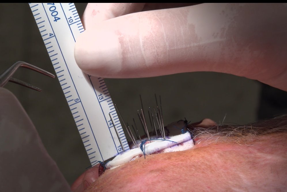 AlphaTauMedical's tweet photo. May is Skin Cancer Awareness Month, and Alpha Tau is excited to get #FDA clearance to expand its clinical trial in skin cancer, now recruiting at #MSK Cancer Center in NYC, to other US sites. New sites will be in community oncology practices. More info at https://t.co/vBz3uGsxkf. https://t.co/cNwrSFSqmx