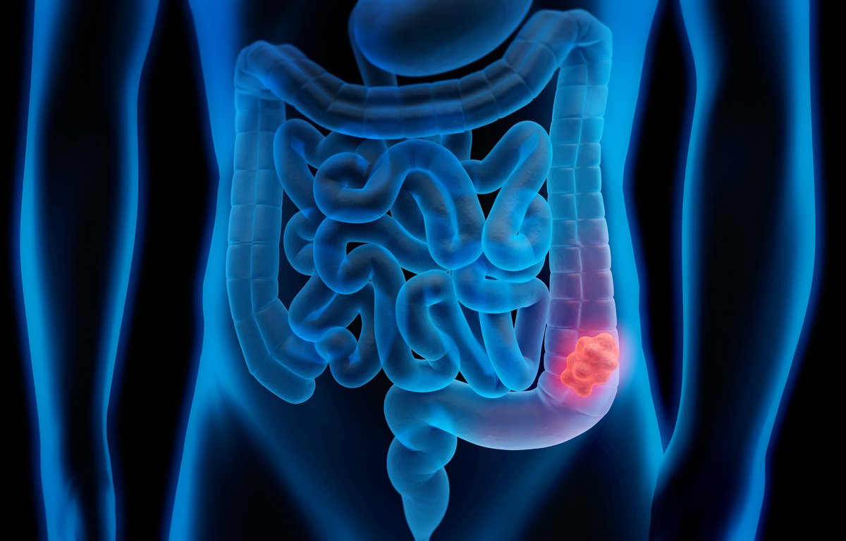 pdcenterlv's tweet photo. The American Cancer Society recommends people at average risk for colorectal cancer begin screening at age 45.
Colon cancer rates have been increasing in younger people. Our CT Colonography helps catch those cancers earlier.
Book your appointment today 📲  https://t.co/WHuK1sUTXt https://t.co/9PCo5fkfxA