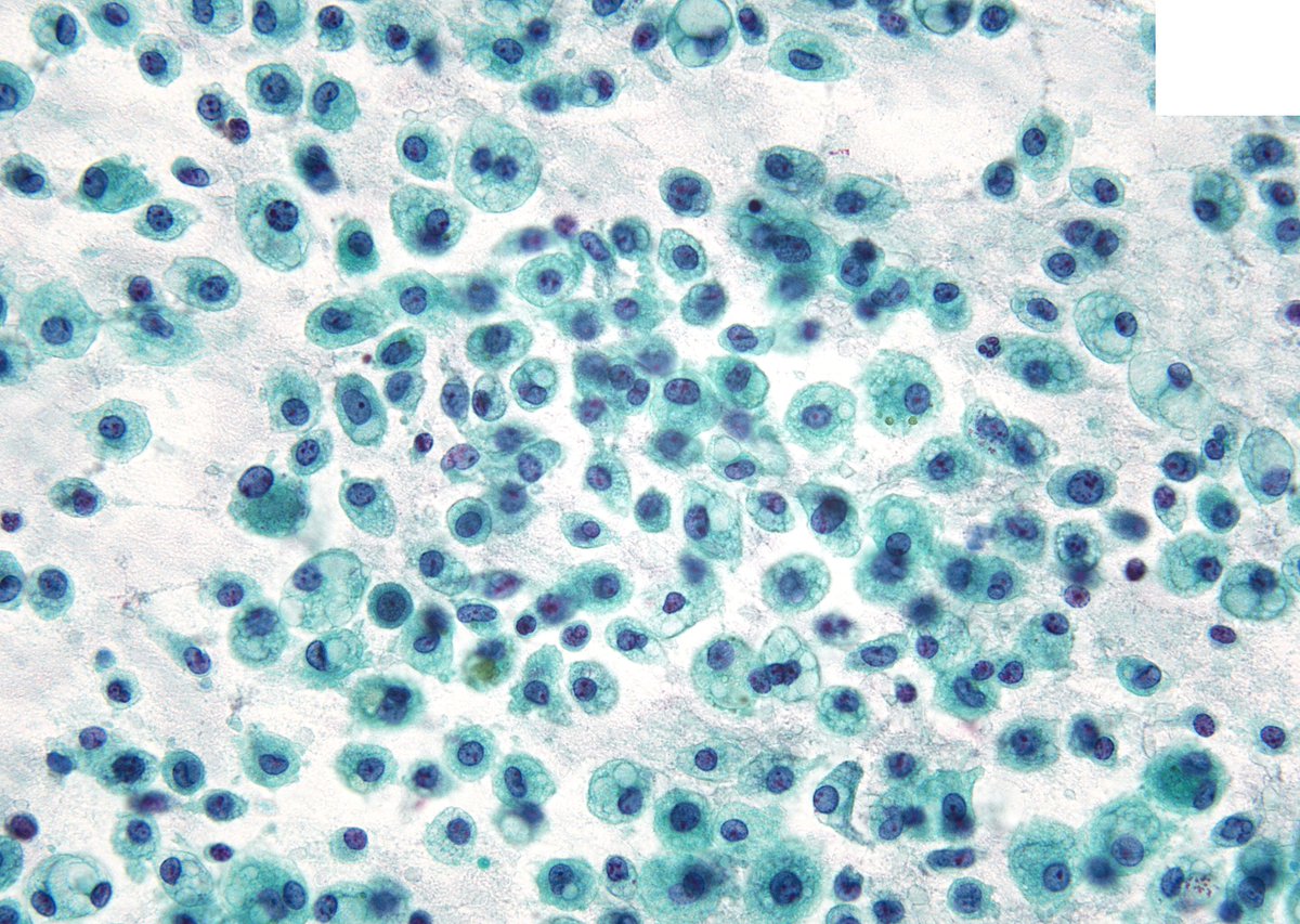 sza_jhcyto's tweet image. Salivary gland "Acinic Cell Carcinoma" may occasionally assumes a very "histiocytic" appearance on FNA, as nicely shown in this case. DD in such scenario includes - Mucoepidermoid CA, Secretory CA, Metastatic RCC and Benign cyst with macrophages.