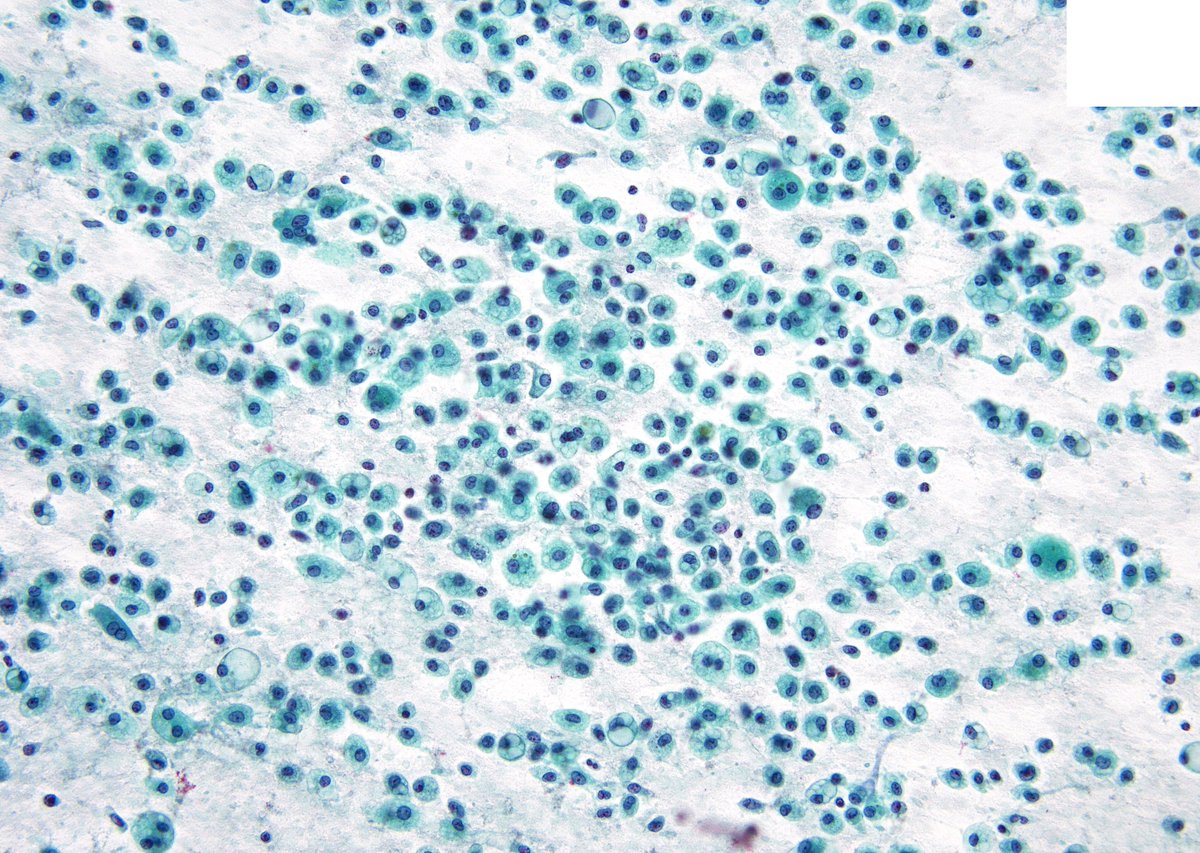 sza_jhcyto's tweet image. Salivary gland "Acinic Cell Carcinoma" may occasionally assumes a very "histiocytic" appearance on FNA, as nicely shown in this case. DD in such scenario includes - Mucoepidermoid CA, Secretory CA, Metastatic RCC and Benign cyst with macrophages.