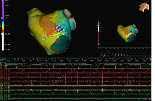 Patient presented with incessant tachycardia after two prior PVI ablations. #HDGrid was used to create an LAT map of the LA, revealing a microreentrant circuit on the anterior wall. 

Review this case and find important safety info: bit.ly/3eG67qJ