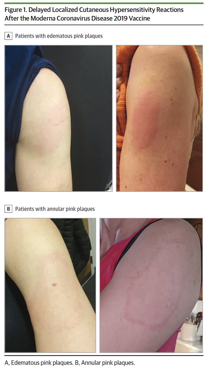 EricTopol's tweet photo. Very rare delayed skin hypersensitivity reactions to @moderna_tx vaccine, aka "covid arm," in 16 people. Median 7 days after 1st dose, 2 days after 2nd dose; no contraindication to 2nd dose @JAMADerm https://t.co/1TXyVeXP2p @YaleMed https://t.co/oX7g47WsmK