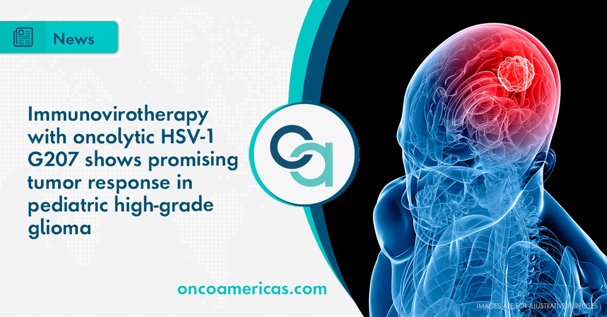 Genetically engineered #herpes simplex virus type 1 G207 converted "cold" tumors into "hot" ones, observing a dramatic increase in tumor-infiltrating lymphocytes in the microenvironment of the #gliomas. Check out the results published on <a href="/NEJM/">NEJM</a>:
bit.ly/3eLfZzP