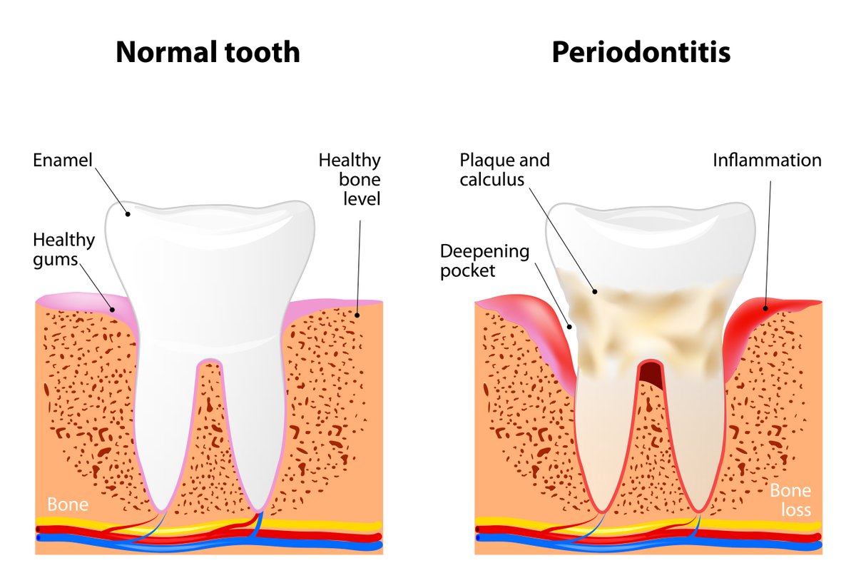 PerioNews's tweet photo. The word periodontal literally means "around the tooth." Periodontal disease, also known as #GumDisease, is a chronic inflammatory disease that affects the gums and bone supporting the teeth. Read on for more information about gum disease. https://t.co/ZV1oKkpf4Z https://t.co/cn52GG5tBc