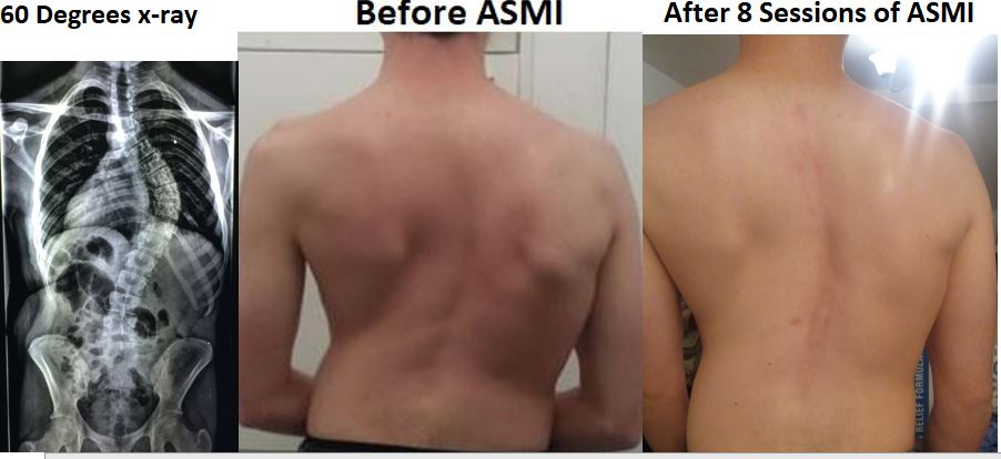 The non-Surgical ASMI does it again for #Scoliosis
