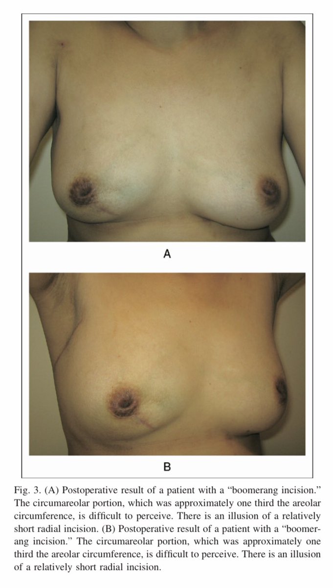 The boomerang incision for periareolar breast malignancies: how to do it ⤵️! #SoMe4Surgery <a href="/herbchen/">herb chen</a> <a href="/pferrada1/">Paula Ferrada MD FACS FCCM MAMSE</a> <a href="/PipeCabreraV/">Dr Luis Felipe Cabrera Vargas MD FACS</a> @cirbosque <a href="/SocietyofBAS/">Society of Black Academic Surgeons</a> <a href="/DChu80/">Daniel I-Hsin Chu | 朱以信</a> <a href="/SWexner/">Steven D Wexner MD, PhD</a> <a href="/juliomayol/">Julio Mayol</a> @MISIRG1 <a href="/WomenSurgeons/">WomenSurgeons</a> <a href="/BrenessaL/">Brenessa Lindeman, MD, MEHP</a>